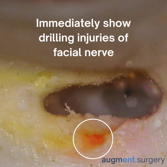 Epsilon-Left OpenEar 3D Temporal Bones