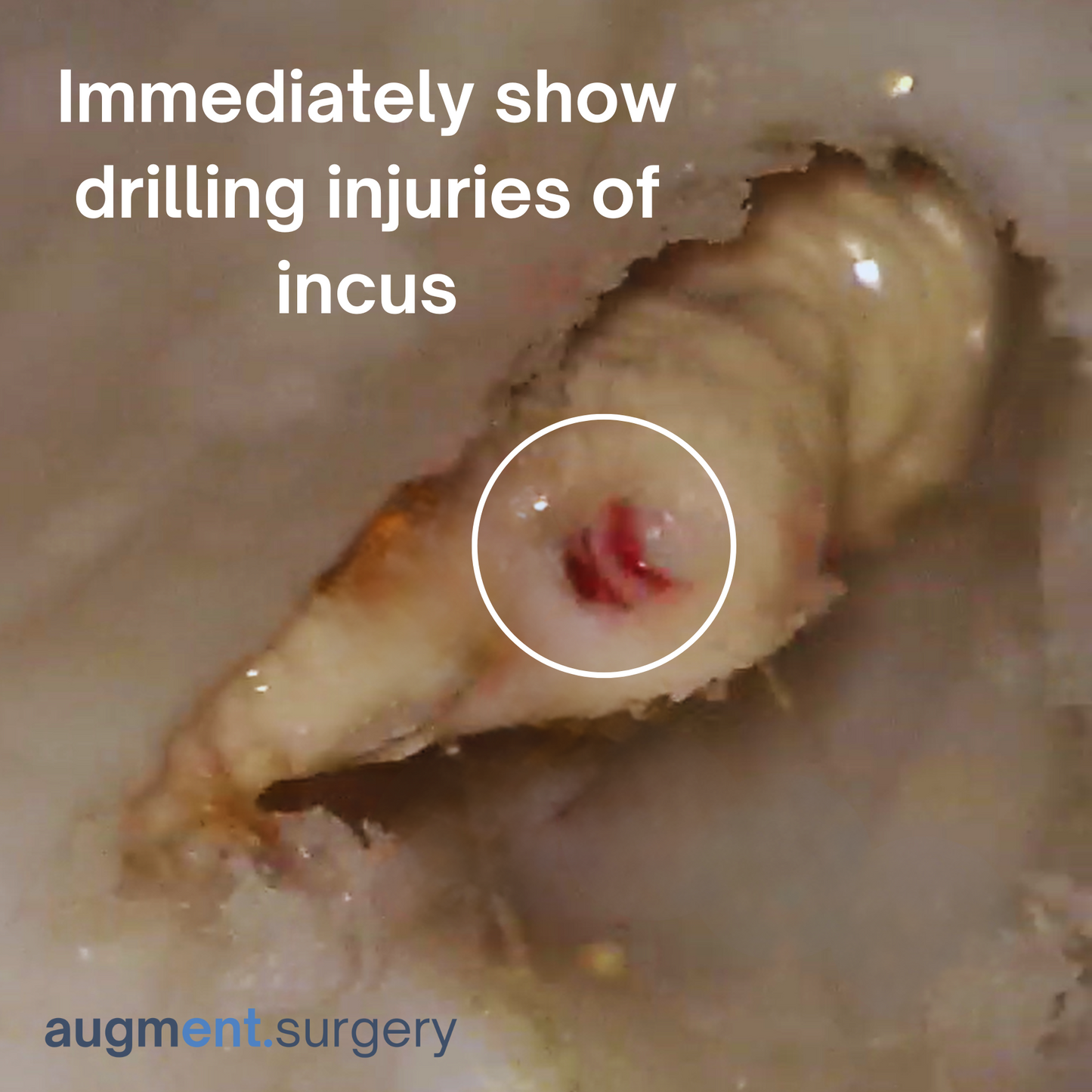 Epsilon-Right OpenEar 3D Temporal Bones