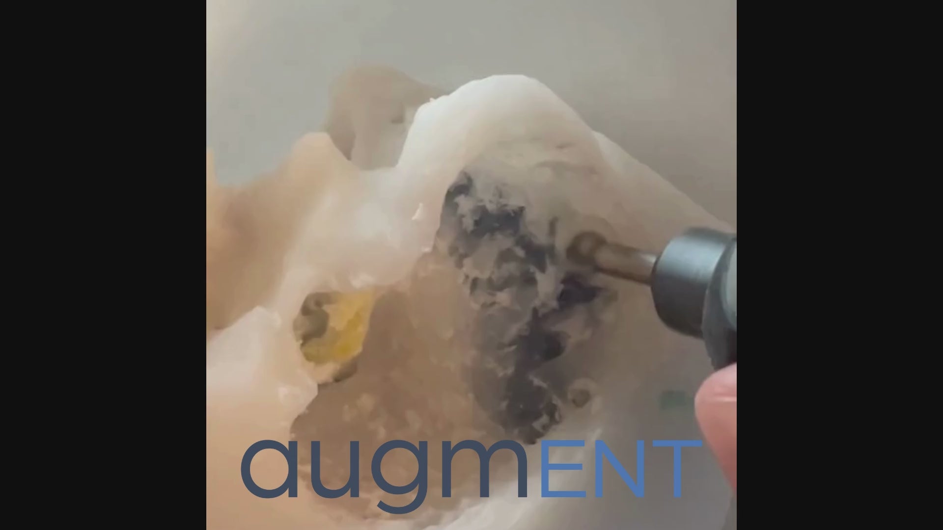 Drilling on 3D printed temporal bone with portable dissection laboratory without irrigation.