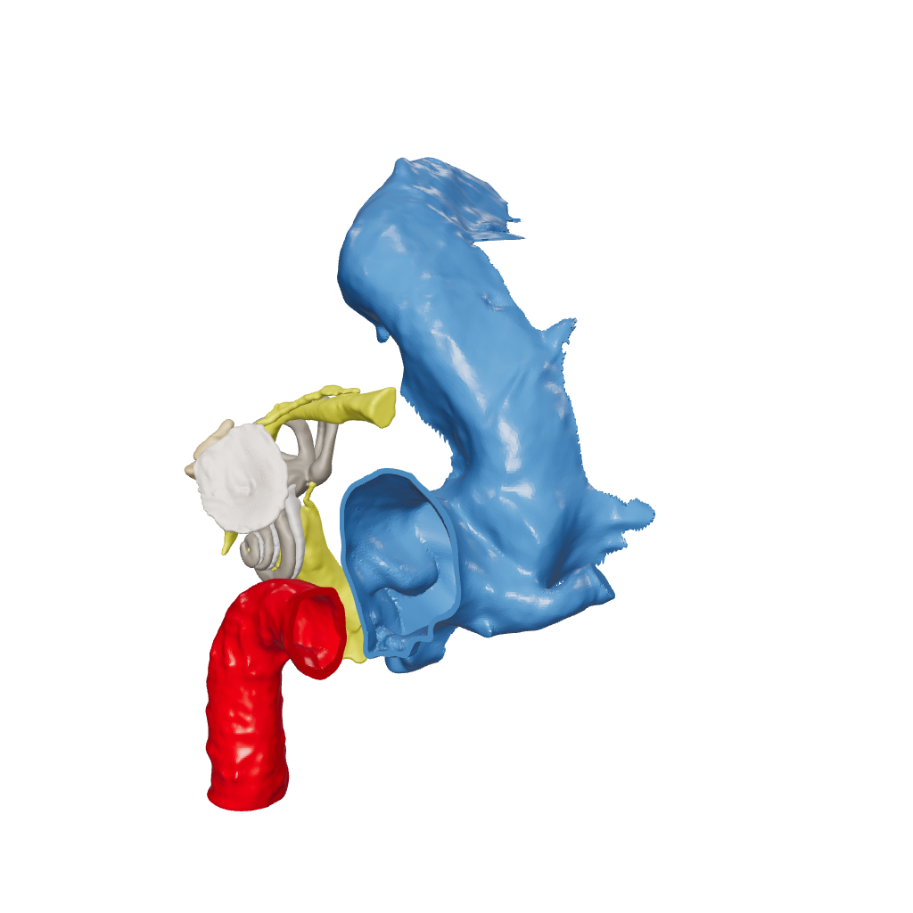 Temporal bone anatomy for OpenEar Theta-Left, remixed by Augment Surgery.