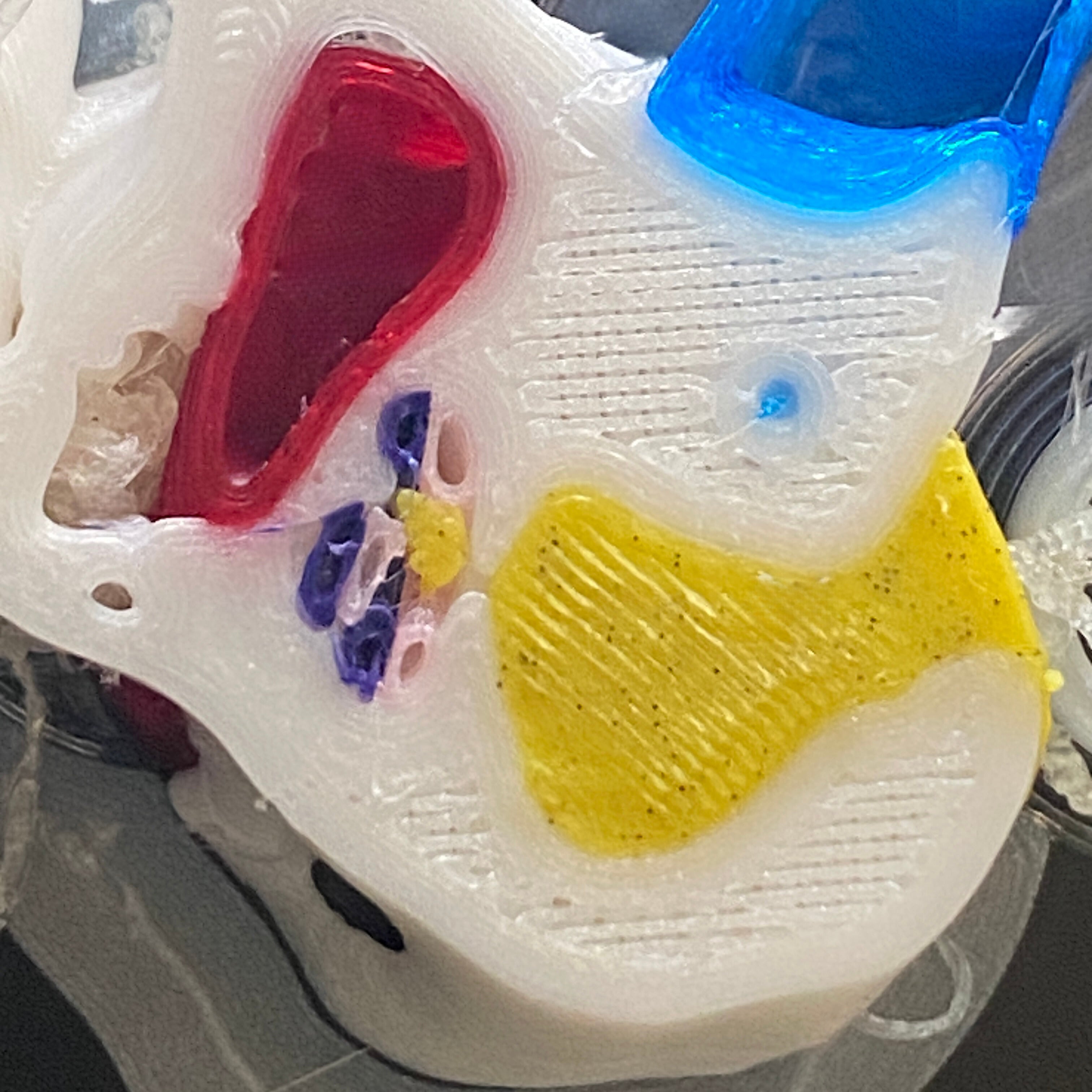 3D temporal bone with dense otic capsule, less dense trabecular bone, hollow scala typmani (pink), hollow scala vestibuli (bluish-purple), carotid lumen (red), jugular bulb lumen (blue), and cochleovestibular nerve (yellow).