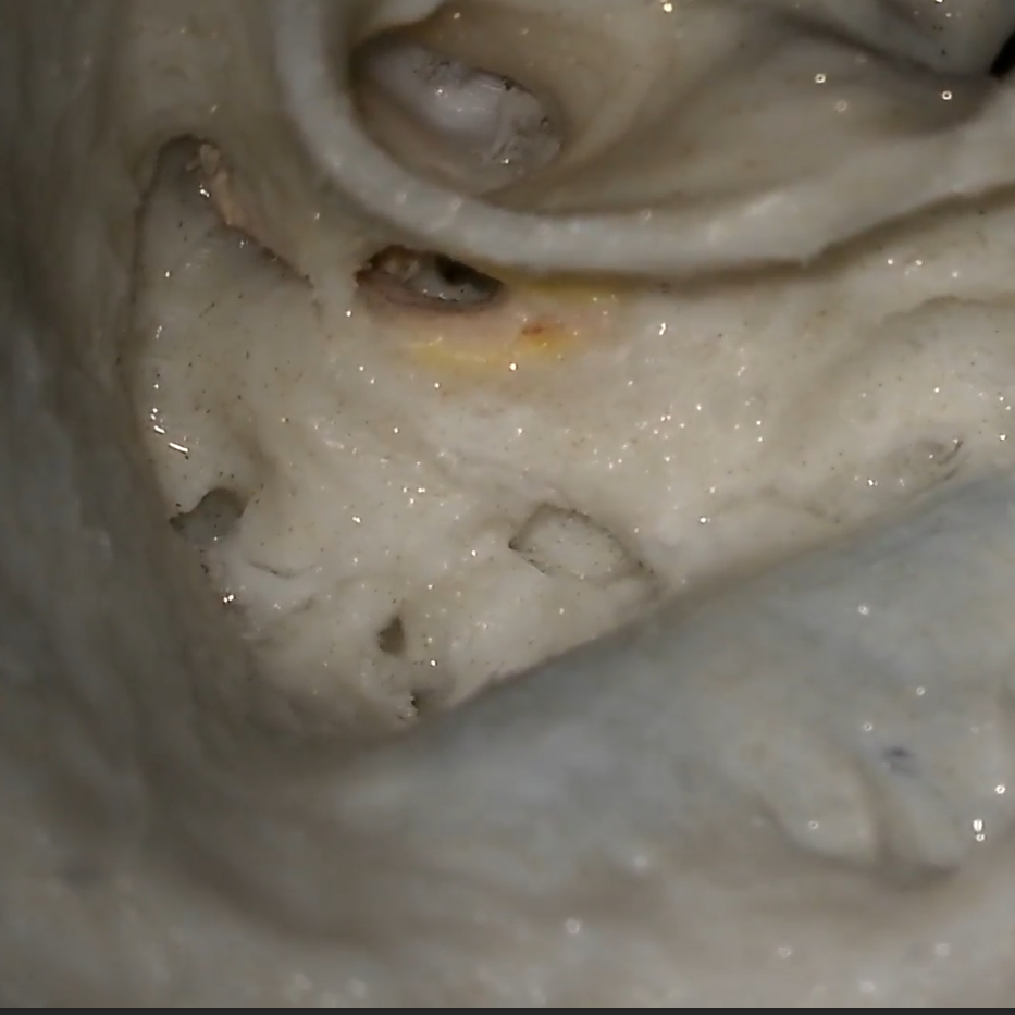 Mastoidectomy and facial recess approach by a neurotologist.