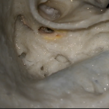 Mastoidectomy and facial recess approach by a neurotologist.