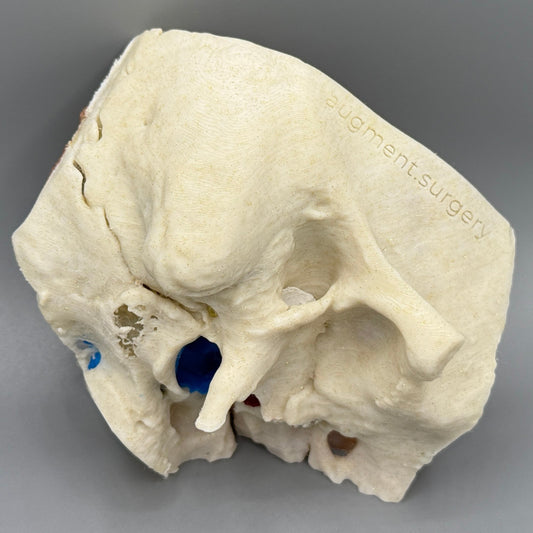 Theta OpenEar Temporal Bones