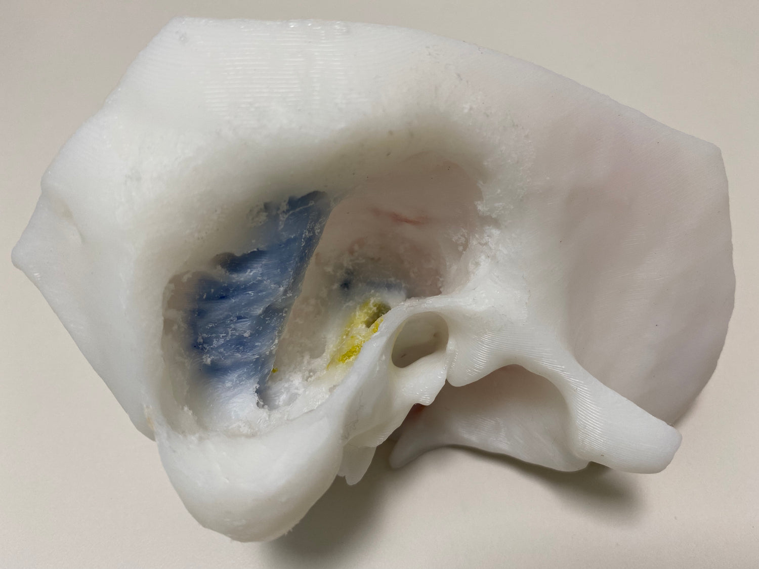 Cortical mastoidectomy and facial recess on 3D printed temporal bone.